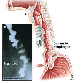 esophageal spasms spasm esophagus nutcracker diffuse corkscrew gastroenterology dysphagia chest swallow pain symptoms syndrome relief barium esophagitis medicine swallowing muscular