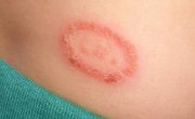 Ringworm (Body) | United-states| PDF | PPT| Case Reports | Symptoms ...