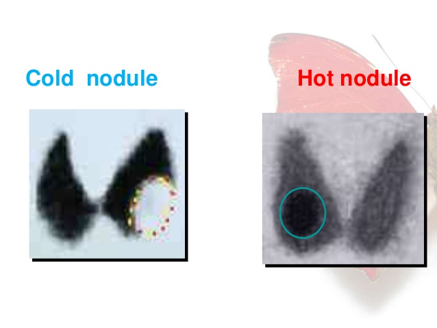 Thyroid nodules China PDF PPT Case Reports