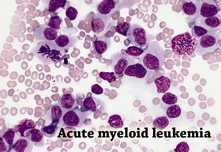 Acute myelogenous leukemia Israel PDF PPT Case Reports Symptoms