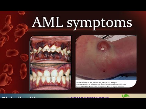 Acute myelogenous leukemia