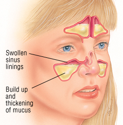 Acute sinusitis | Canada| PDF | PPT| Case Reports | Symptoms | Treatment