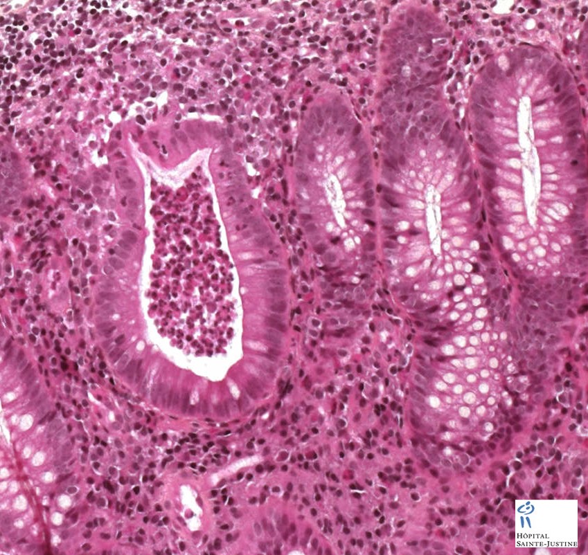 Adult Stills Disease 9534