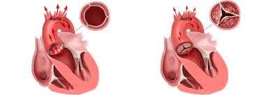 Aortic Valve Disease