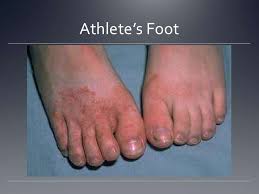 Athletes foot