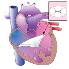 Atrioventricular canal defect