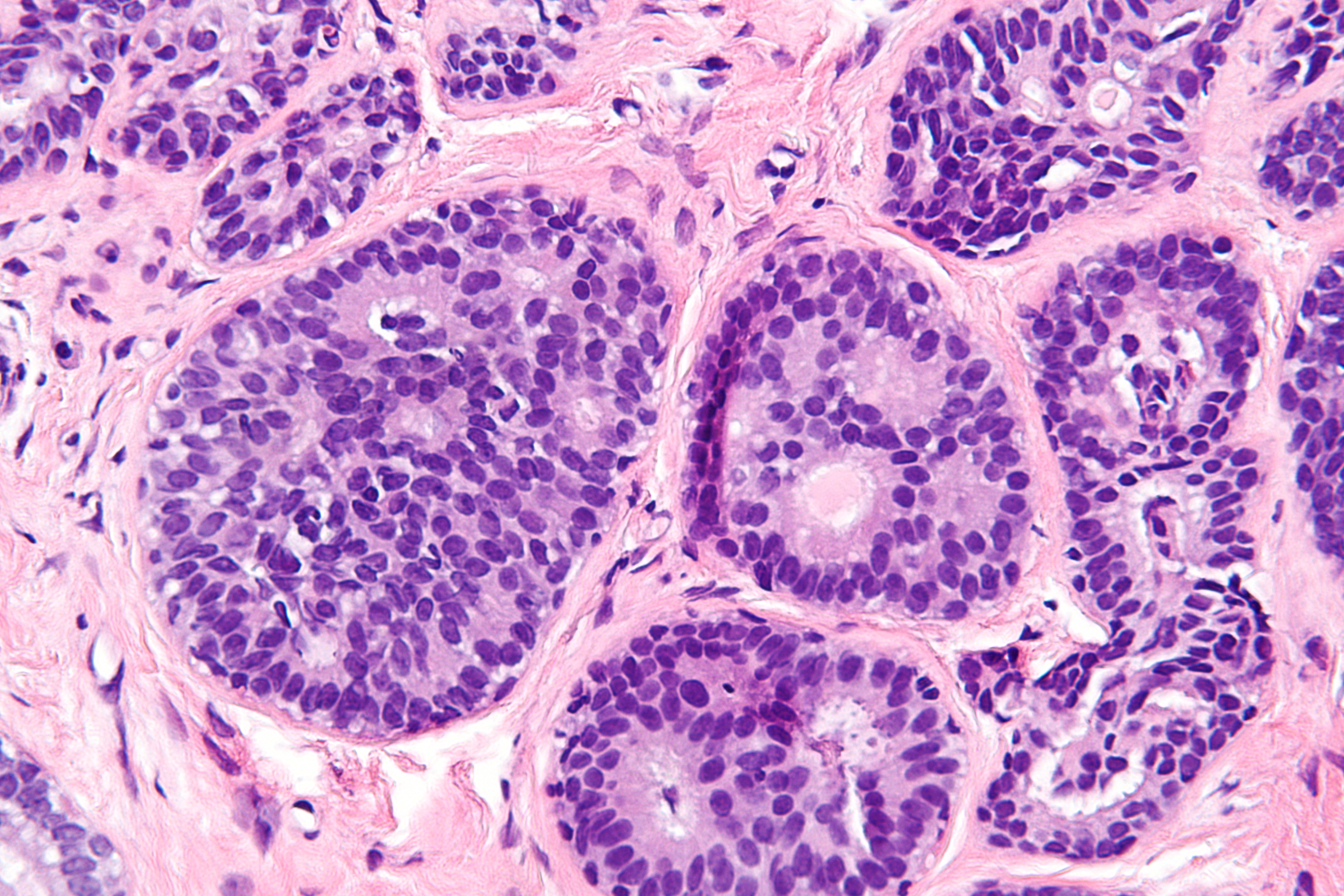 Atypical Cells In Breast Biopsy