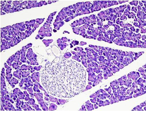 Autoimmune pancreatitis