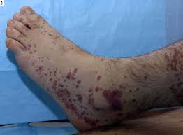 Bergers disease | Canada| PDF | PPT| Case Reports | Symptoms | Treatment