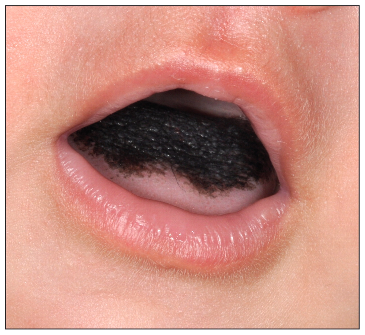 black-hairy-tongue