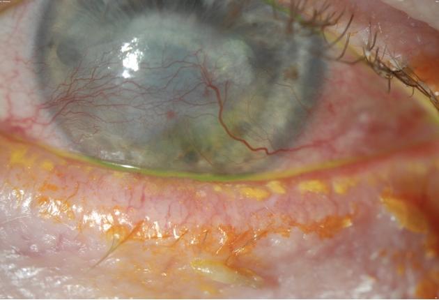 What is Blepharitis?