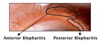 Blepharitis | Hong Kong| PDF | PPT| Case Reports | Symptoms | Treatment