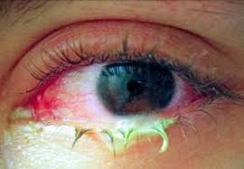 Blocked tear duct | Spain| PDF | PPT| Case Reports | Symptoms | Treatment