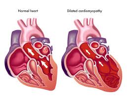 Bradycardia