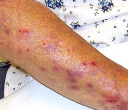 Calciphylaxis | India| PDF | PPT| Case Reports | Symptoms | Treatment