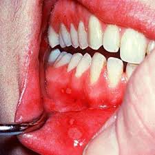 Canker sore