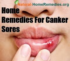 Canker sore