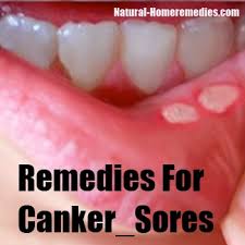 Canker sore