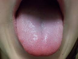 Canker sore