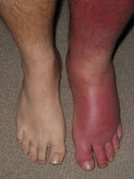 Cellulitis