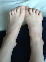 Charcot-Marie-Tooth disease