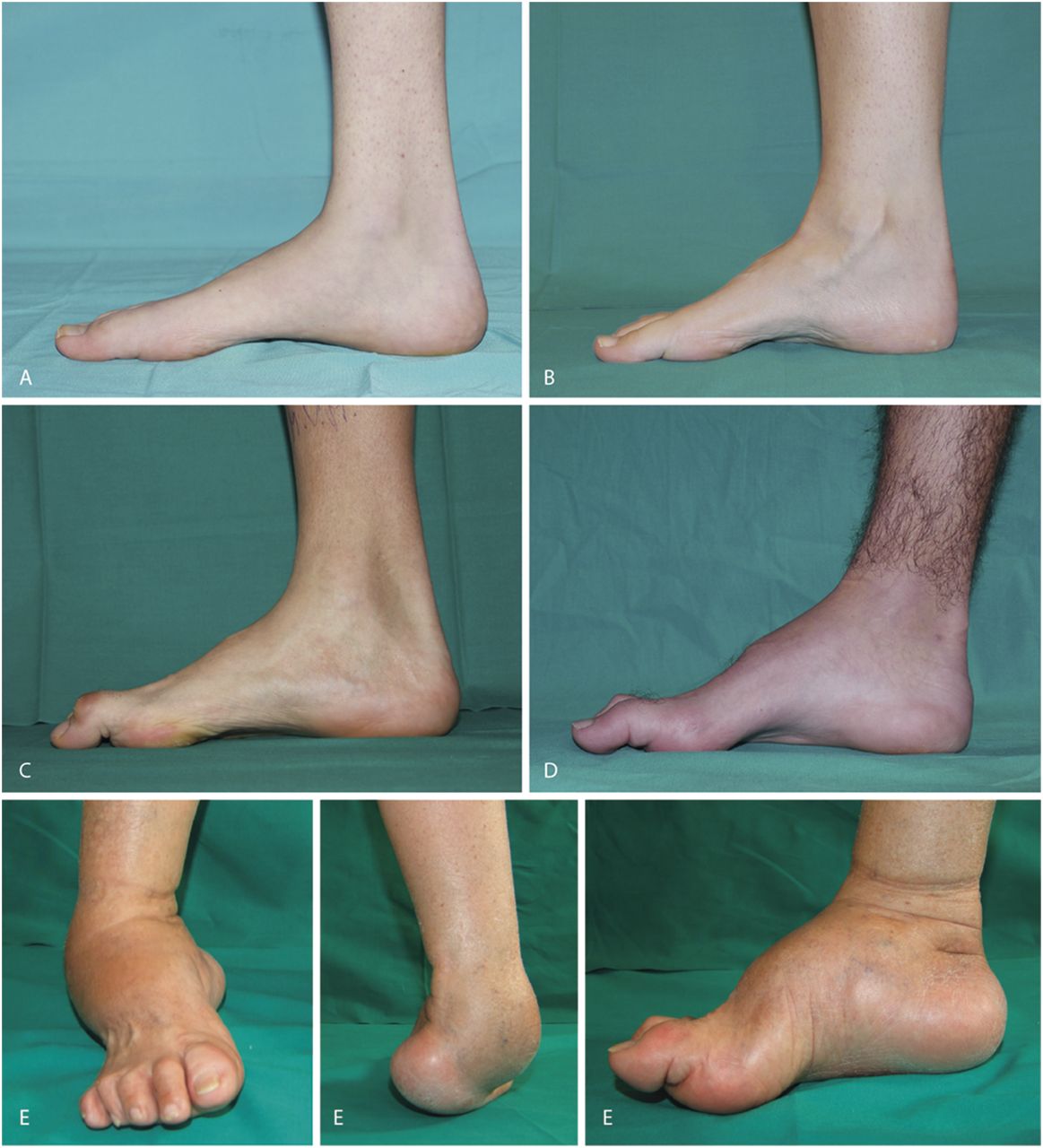 Charcot-Marie-Tooth disease