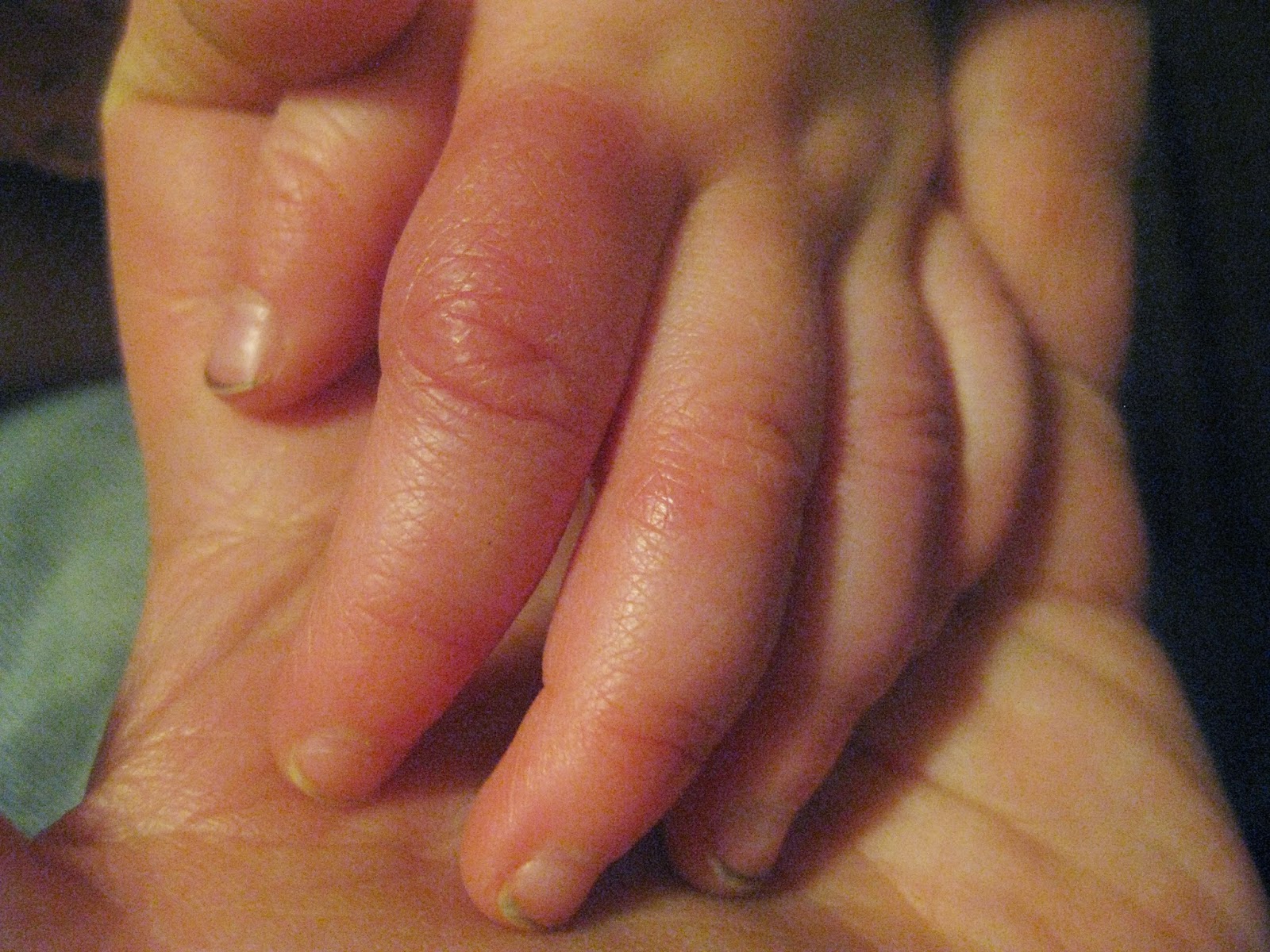 Red Swollen Itchy Fingers In Winter