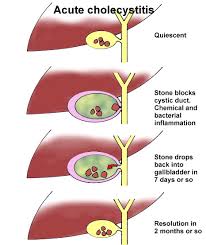 Cholecystitis | United States| PDF | PPT| Case Reports | Symptoms ...