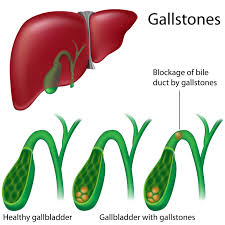 Cholecystitis