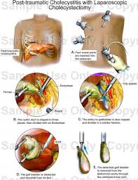  Cholecystitis Singapore PDF PPT Case Reports Symptoms Treatment