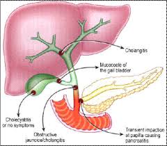 Cholecystitis