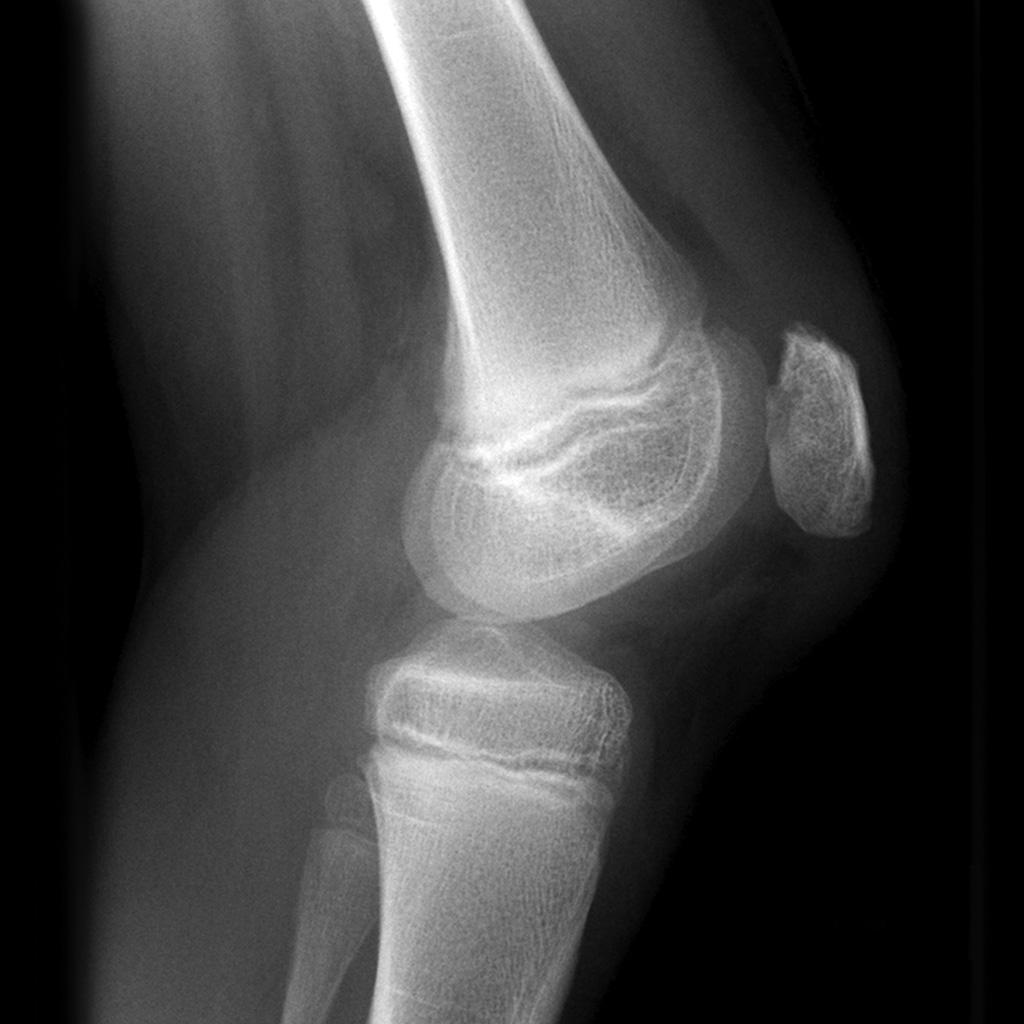 Knee Joint With Patellar Chondromalacia Chondromalaci - vrogue.co