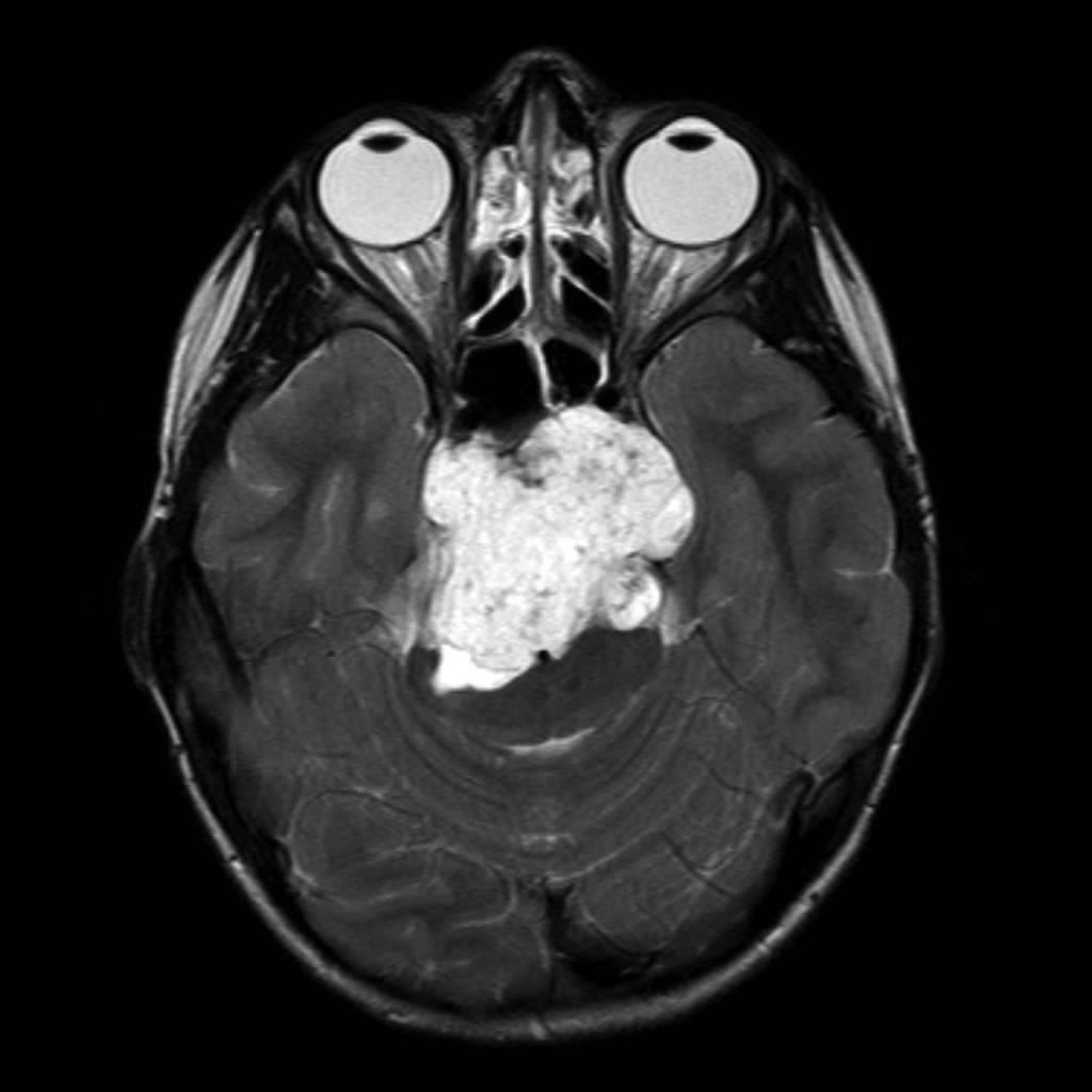 Chordoma | UK| PDF | PPT| Case Reports | Symptoms | Treatment