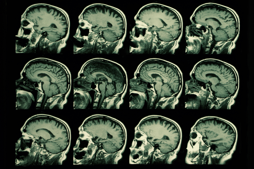 chronic-traumatic-encephalopathy