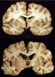 Chronic traumatic encephalopathy