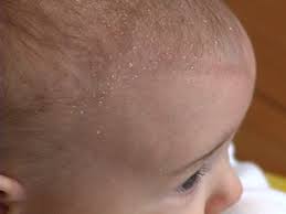 selsun blue for cradle cap