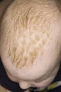 Cradle cap