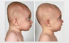 Craniosynostosis | Poland| PDF | PPT| Case Reports | Symptoms | Treatment