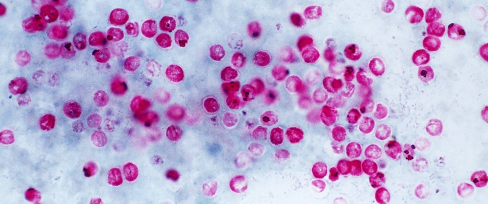 cryptosporidiosis