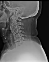 Diffuse idiopathic skeletal hyperostosis