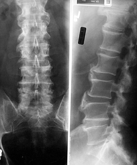 Diffuse idiopathic skeletal hyperostosis | Norway | PDF | PPT| Case ...