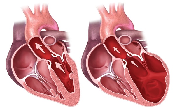 Dilated cardiomyopathy