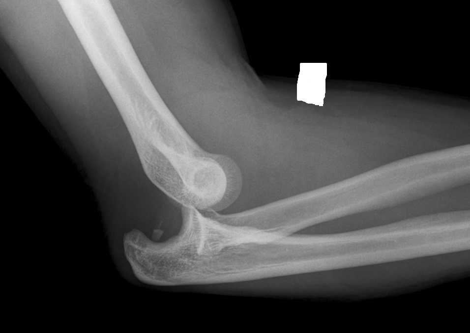 Dislocated elbow | Norway| PDF | PPT| Case Reports | Symptoms | Treatment