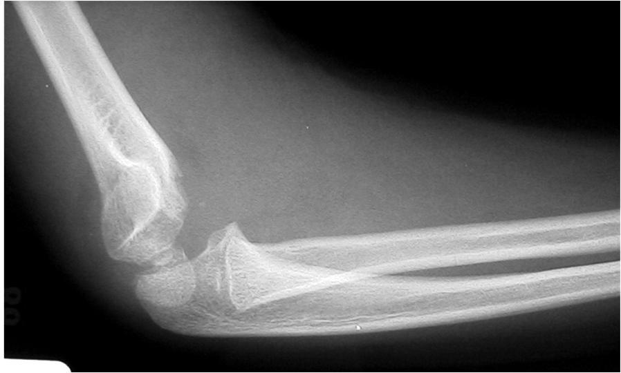 Dislocated elbow | Norway| PDF | PPT| Case Reports | Symptoms | Treatment