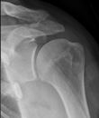 Dislocated shoulder | France| PDF | PPT| Case Reports | Symptoms ...