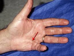 Dupuytren's contracture