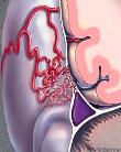 Dural arteriovenous fistulas