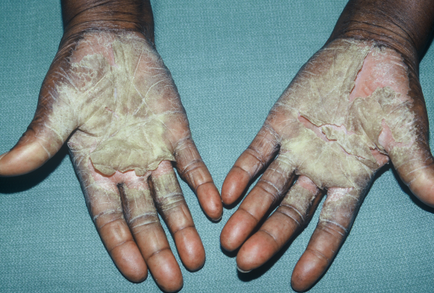 Dyshidrosis India Pdf Ppt Case Reports Symptoms Treatment