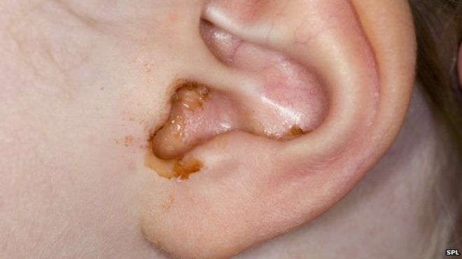 Earwax Blockage India PDF PPT Case Reports