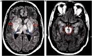 Eastern Equine Encephalitis